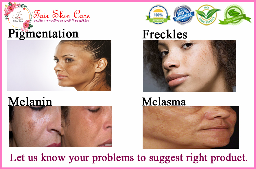 Freckles, Melanin, Pigmentation, Melasma